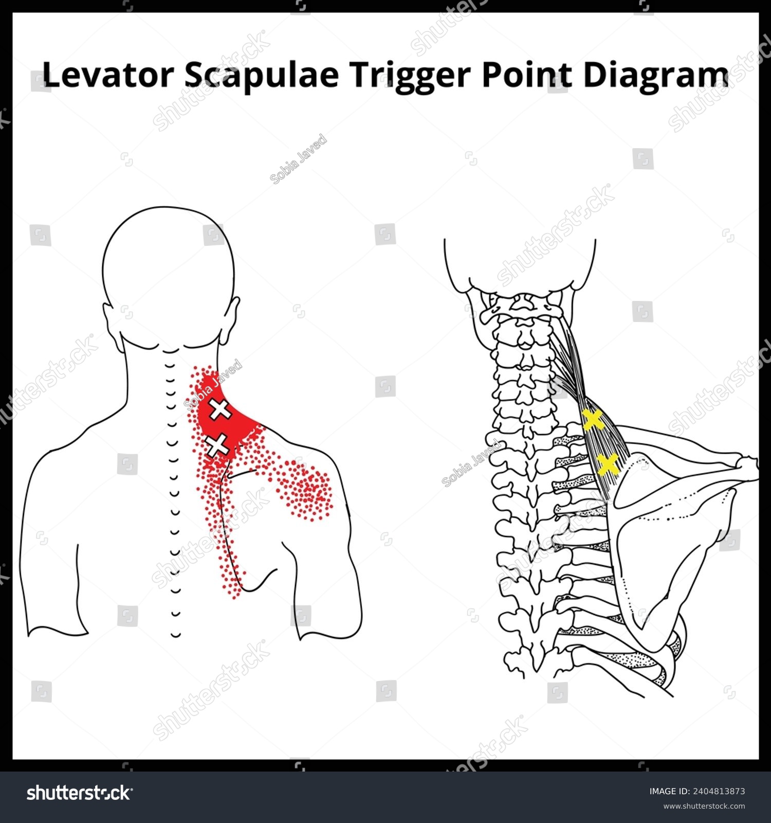 Levator Scapulae Trigger Point Diagram, Trigger - Royalty Free Stock ...