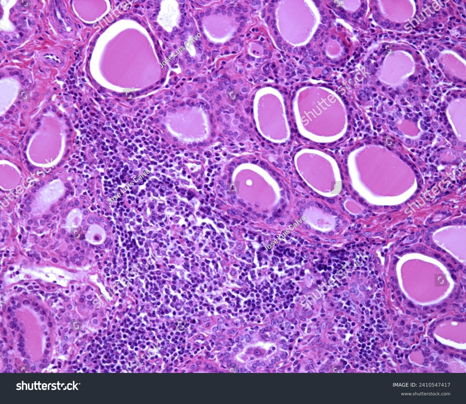 Light micrograph of a human thyroid with chronic thyroiditis (Hashimoto disease). There are extensive chronic inflammatory infiltrates and lymphoid follicles with germinal centres. #2410547417