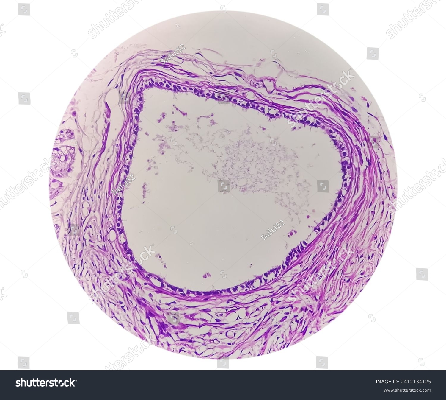 Histology, Peritoneal inclusion cyst. - Royalty Free Stock Photo ...