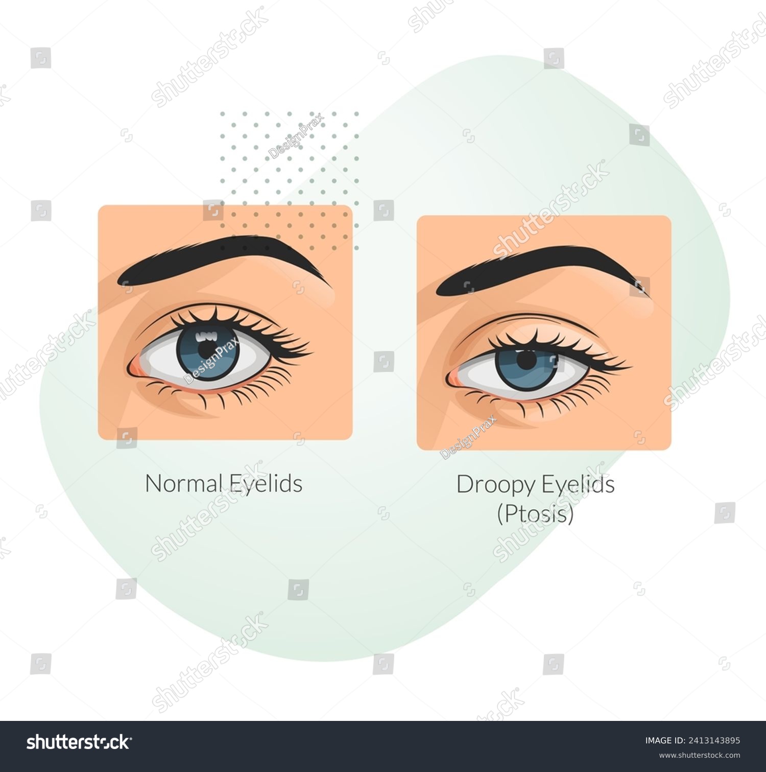 Ptosis drooping upper eyelid - Stock - Royalty Free Stock Vector ...