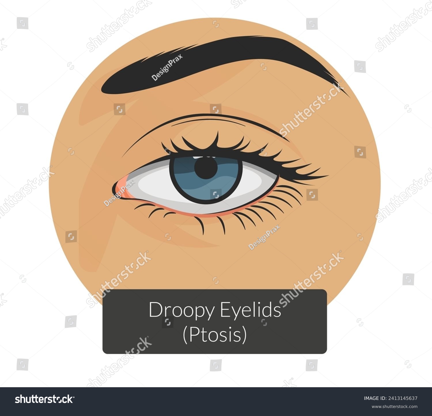 Ptosis drooping upper eyelid - Stock - Royalty Free Stock Vector ...