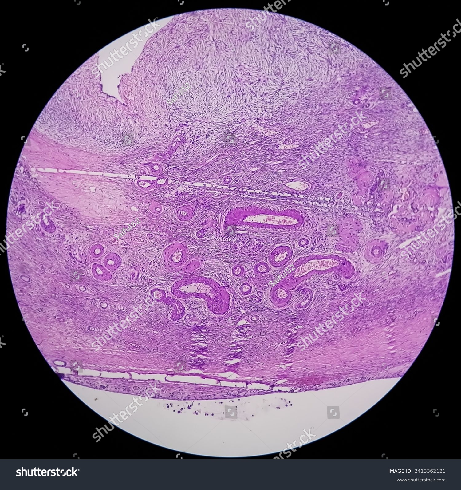 Histology, Peritoneal inclusion cyst. - Royalty Free Stock Photo ...