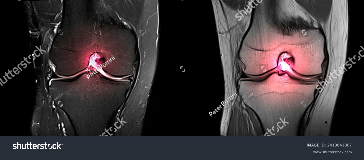 Magnetic resonance imaging or MRI of knee.Closed injury of the knee joint, with manifestations of arthrosis.Knee pain in sport injury.Orthopedic surgeon plan cruciate ligament reconstruction surgery. #2413641807