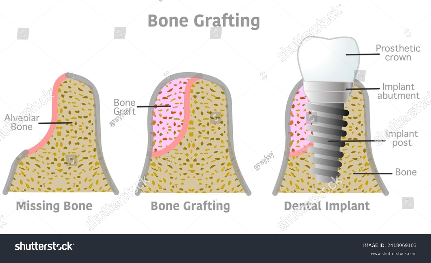 Bone grafting implant steps anatomy, teeth - Royalty Free Stock Vector ...