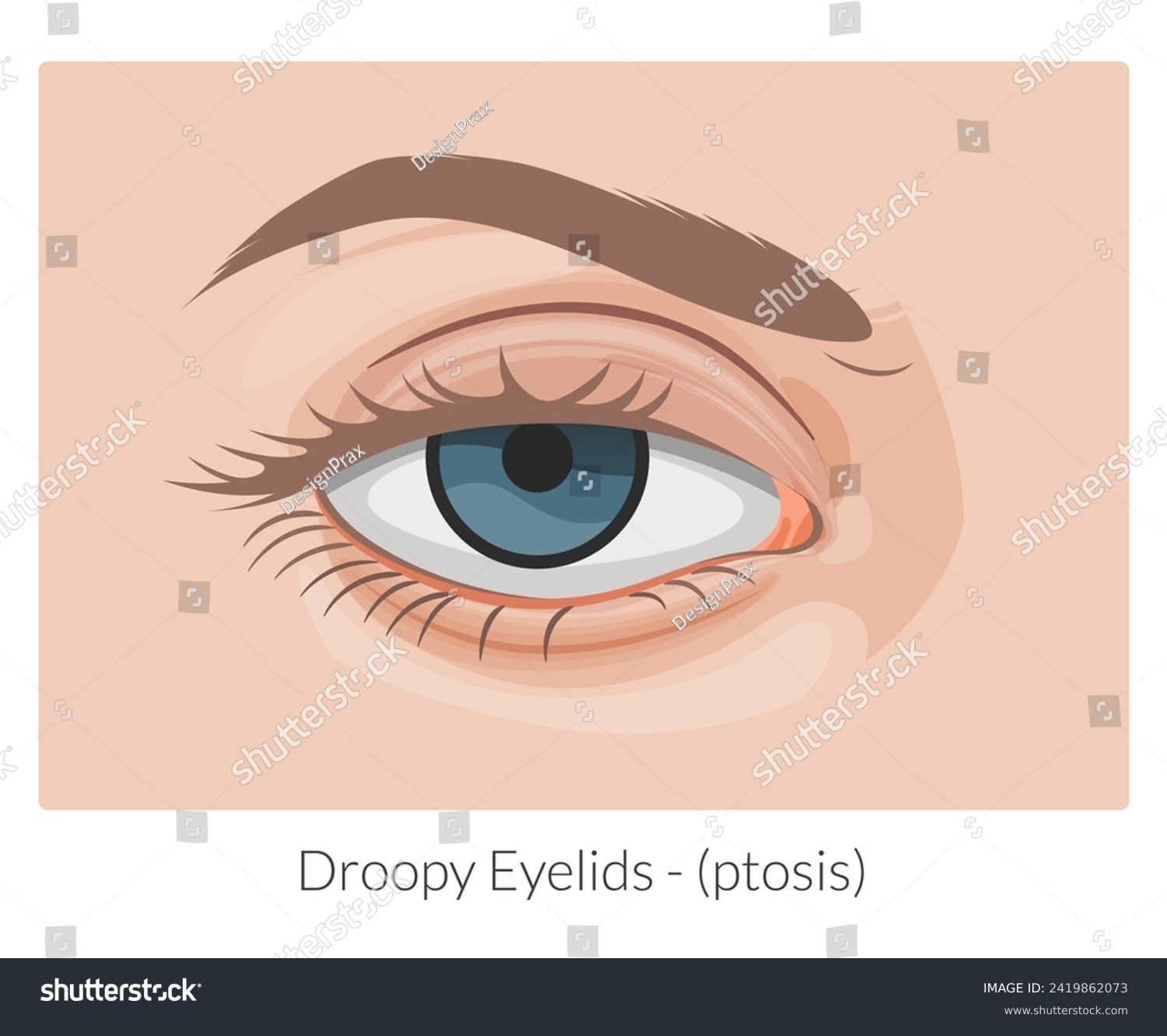 Ptosis drooping upper eyelid - Stock - Royalty Free Stock Vector ...