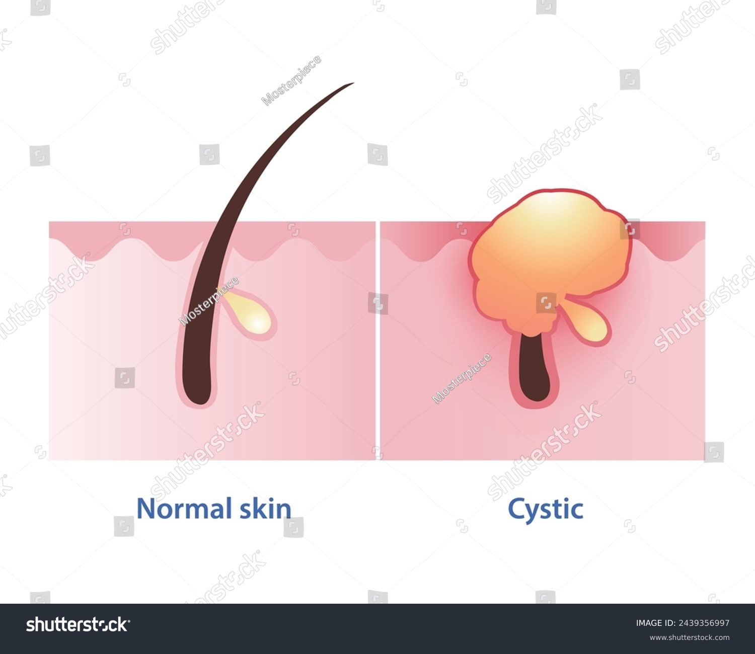 Cystic acne, the most severe type of - Royalty Free Stock Vector ...