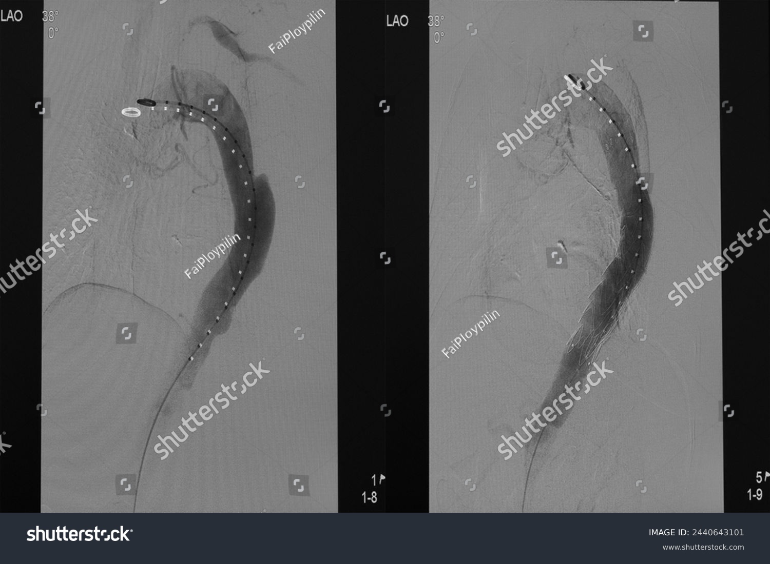 Comparison of pre-post thoracic endovascular aneurysm repair (TEVAR) at descending aorta with aortic stent graft. #2440643101