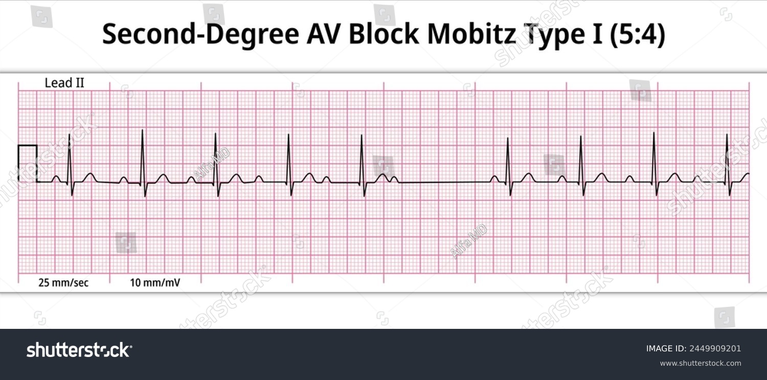 ECG Second Degree AV Block Mobitz Type 1 (5:4) - Royalty Free Stock ...