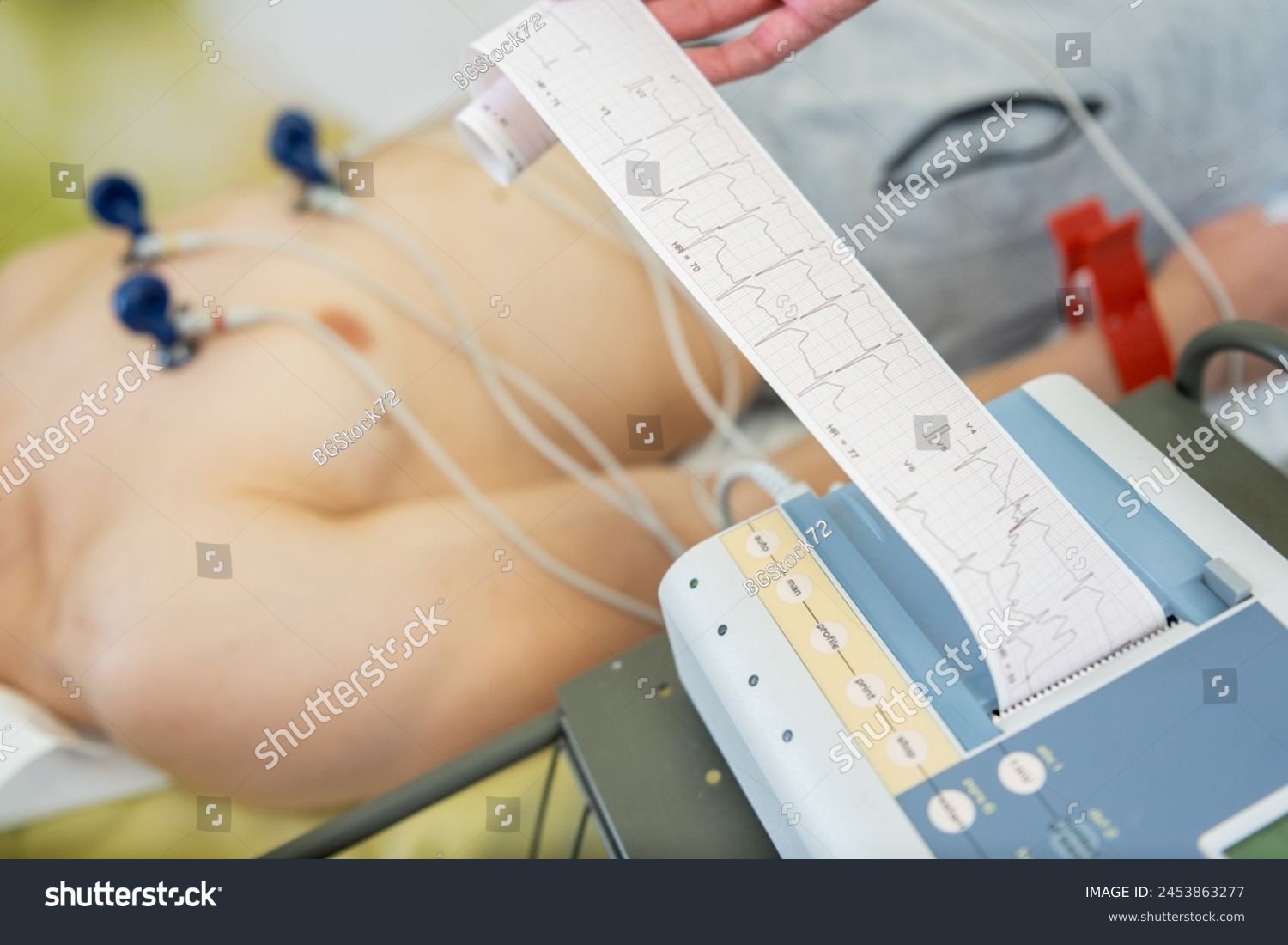 A patient undergoing an electrocardiogram test with electrodes attached to the chest, as a healthcare professional examines the ECG readout. #2453863277