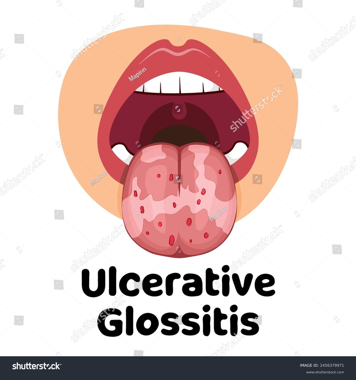 Illustration Of The Oral Infection Disease Royalty Free Stock Vector 2456379971 0654