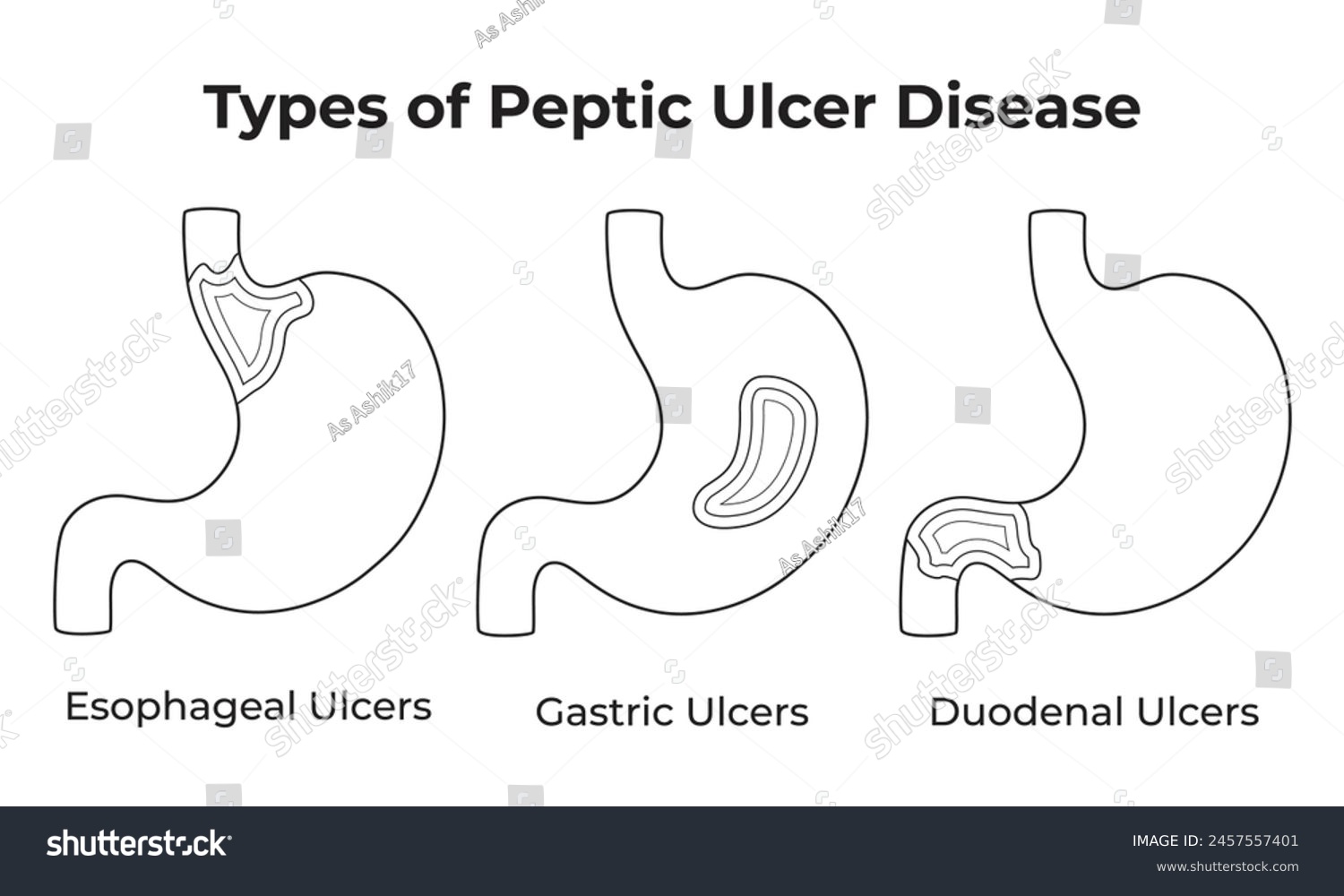 Types of Peptic Ulcer Disease Science Design - Royalty Free Stock ...