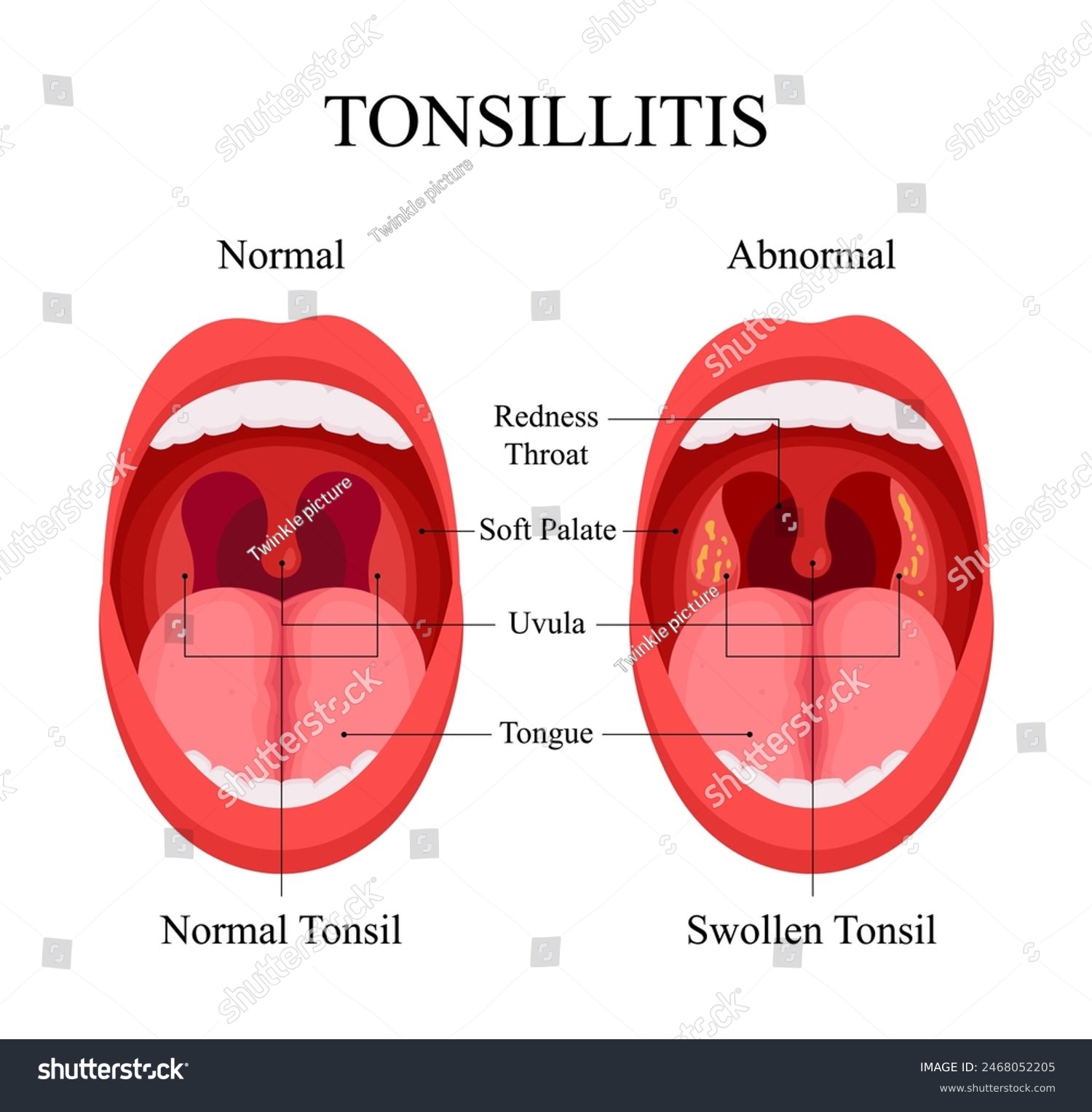 Diagram of Tonsillitis Causes, Normal Tonsils - Royalty Free Stock ...