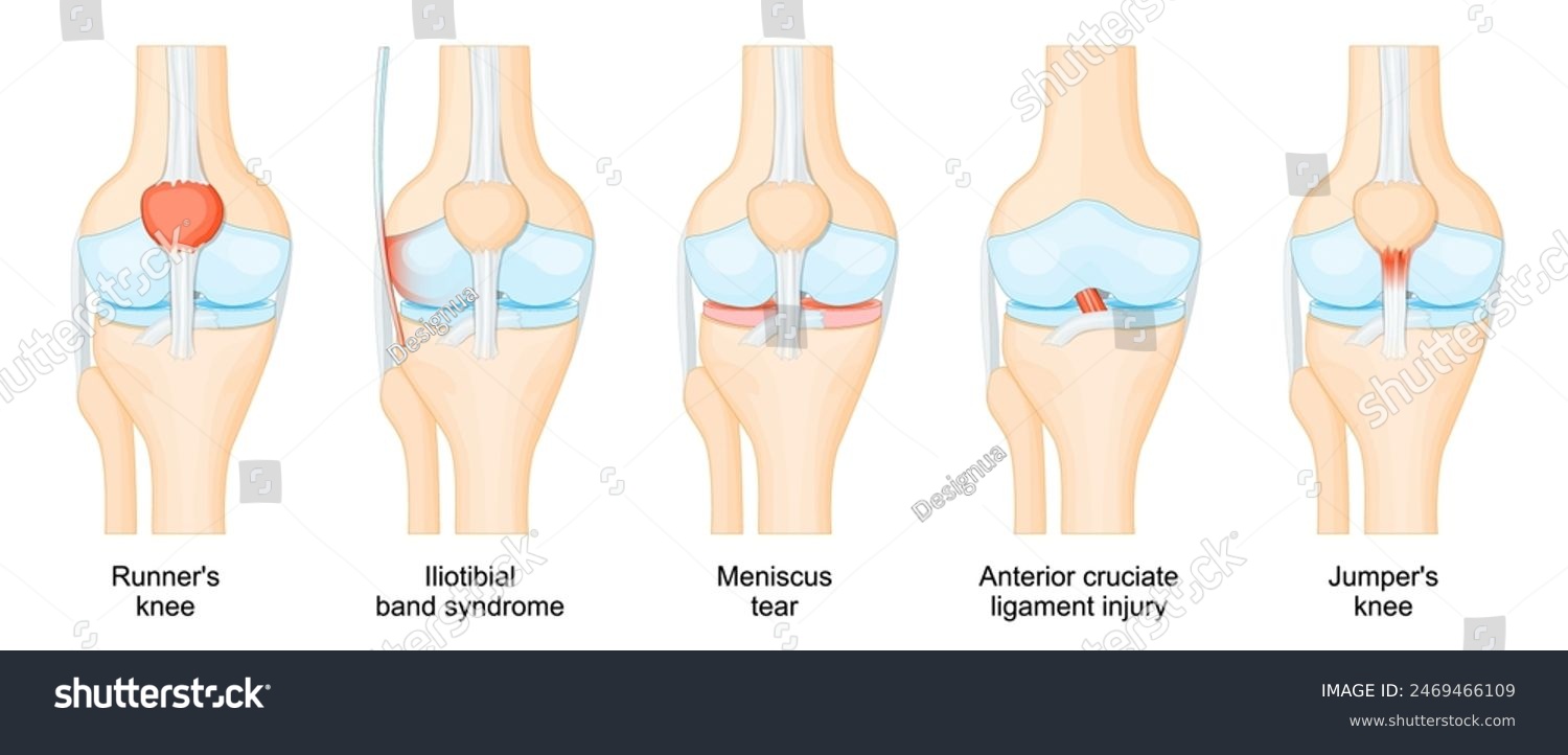 Knee injuries. Anatomy of human knee joint. - Royalty Free Stock Vector ...