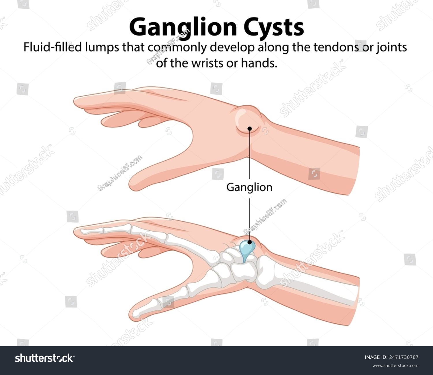 Illustration Of Ganglion Cysts On Wrist And Hand Royalty Free Stock