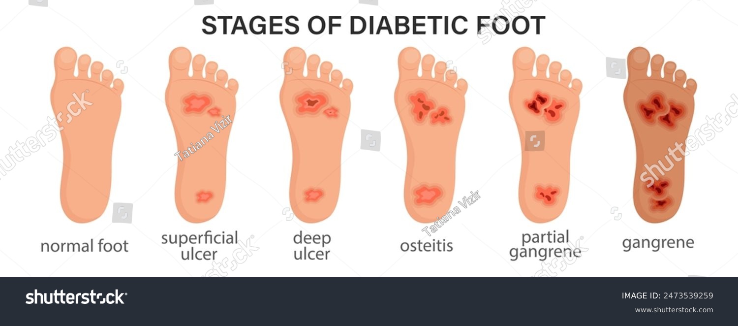 Stages of diabetic foot syndrome. Deep ulcer, - Royalty Free Stock ...