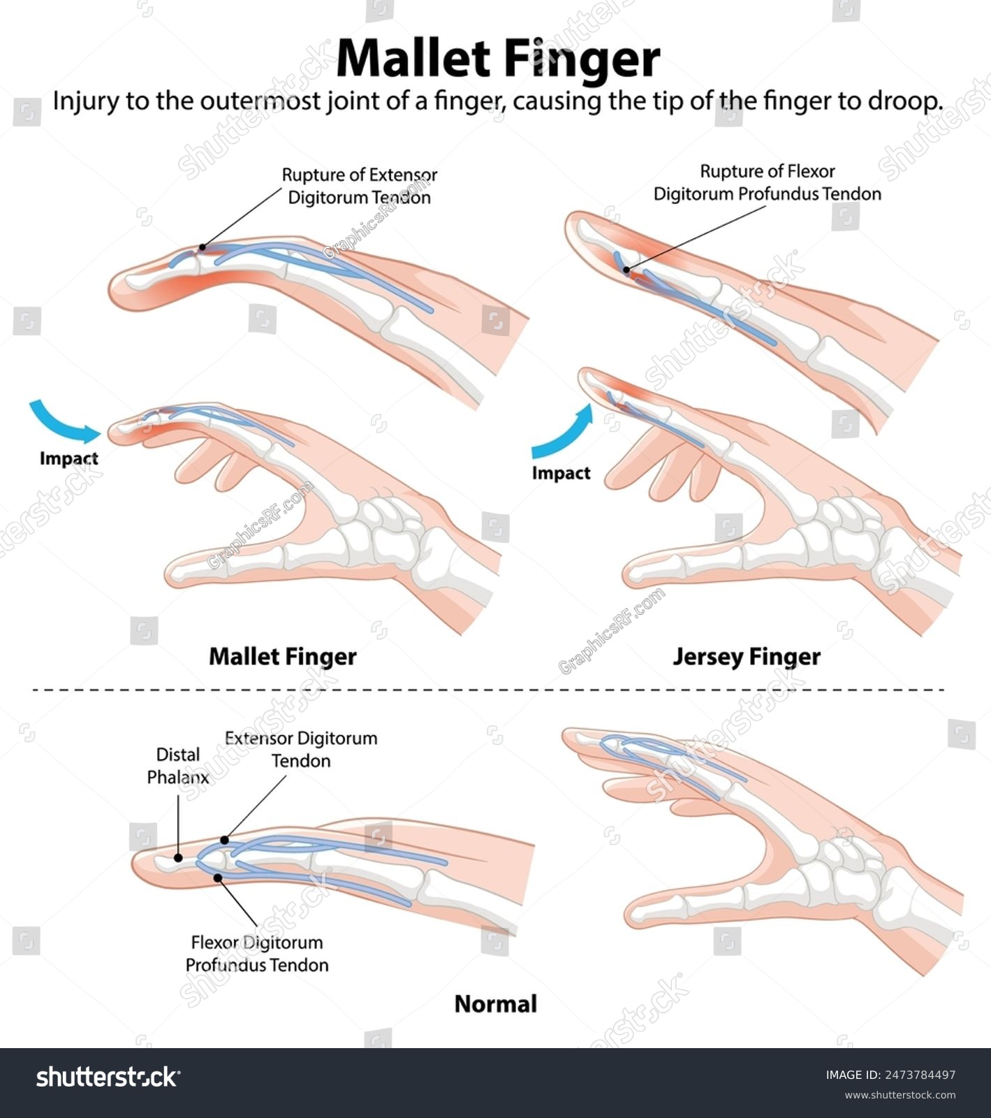 Diagram showing mallet and jersey finger - Royalty Free Stock Vector ...