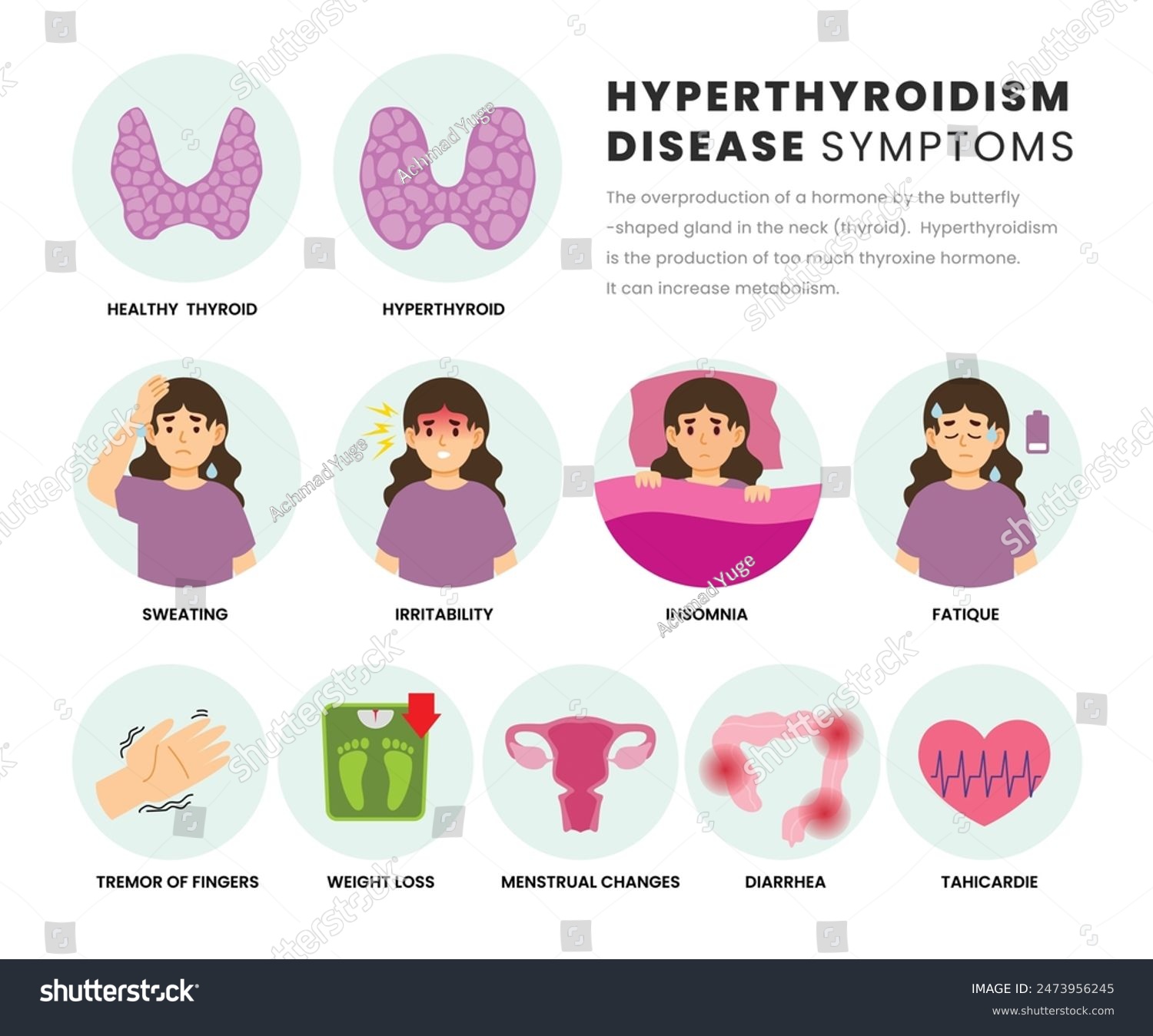 Hyperthyroidism symptoms infographic medical - Royalty Free Stock ...