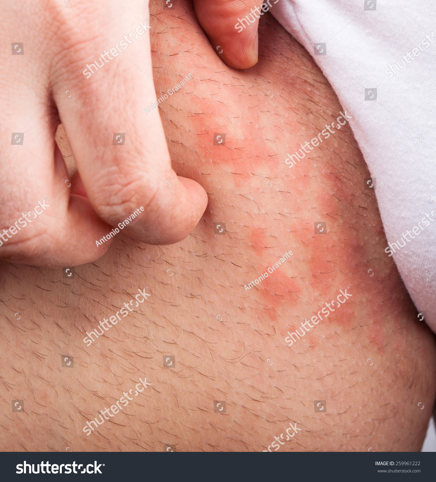 urticaria cuero cabelludo royalty free eczema groin atopic dermatitis symptom urticaria cuero cabelludo royalty free eczema groin atopic dermatitis symptom
