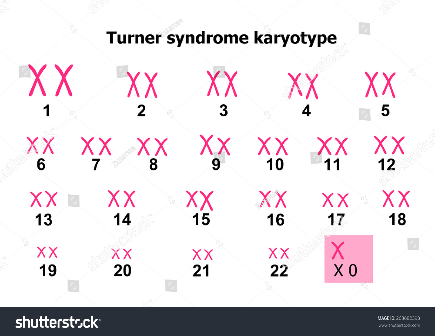 Turner syndrome karyotype Royalty Free Stock Photo 263682398