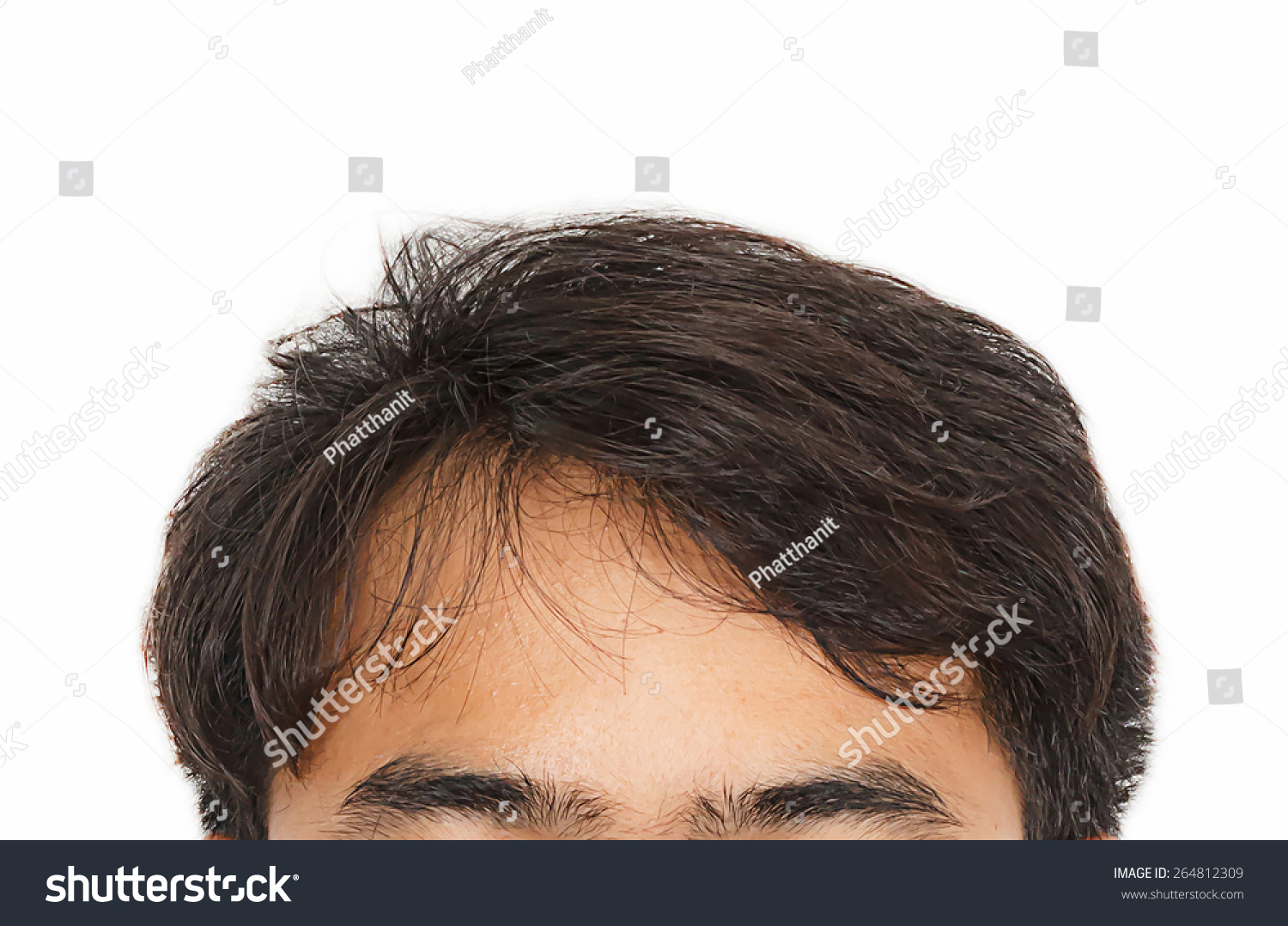 Male Head With Hair Loss Symptoms Front Side Royalty Free Stock Photo 264812309 Avopix Com