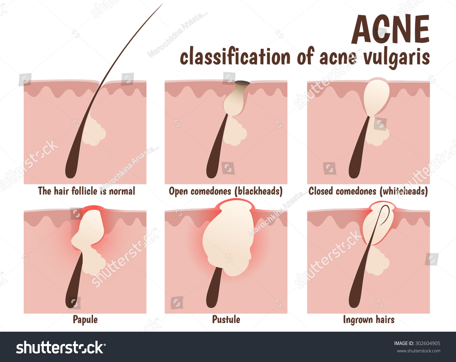 structure of the hair follicle, problem skin - Royalty Free Stock ...