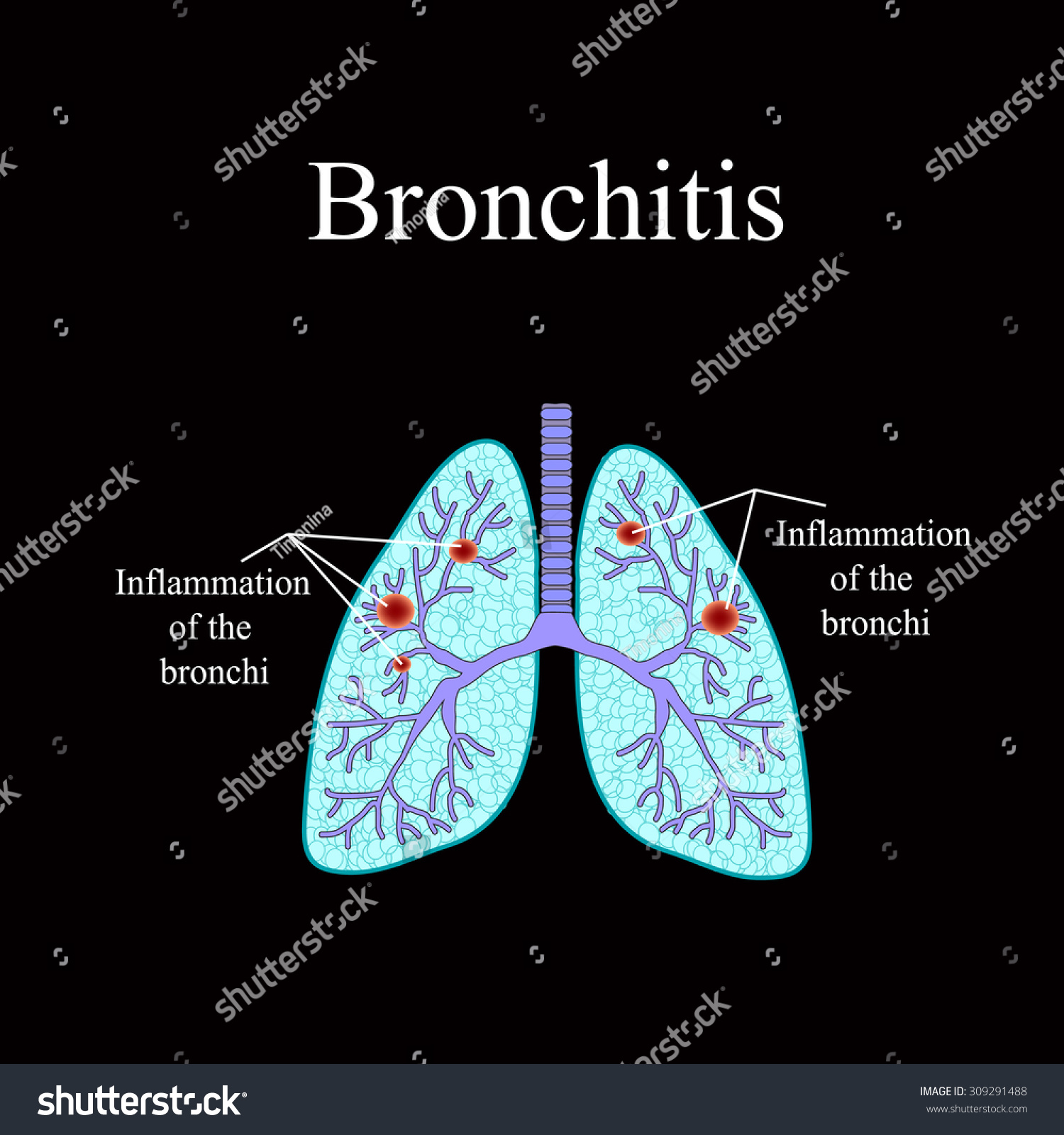 Bronchitis The Anatomical Structure Of The Royalty Free Stock Vector