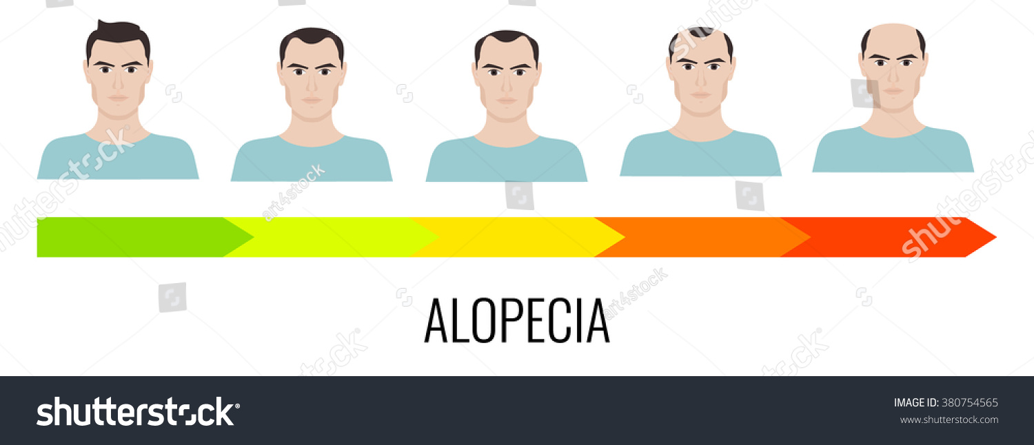 Alopecia Stages Set. Front View Of A Man Losing - Royalty Free Stock ...