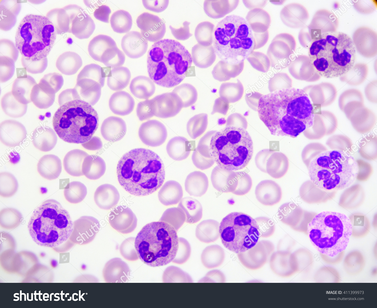 Neutrophil cell (white blood cell) in peripheral - Royalty Free Stock ...