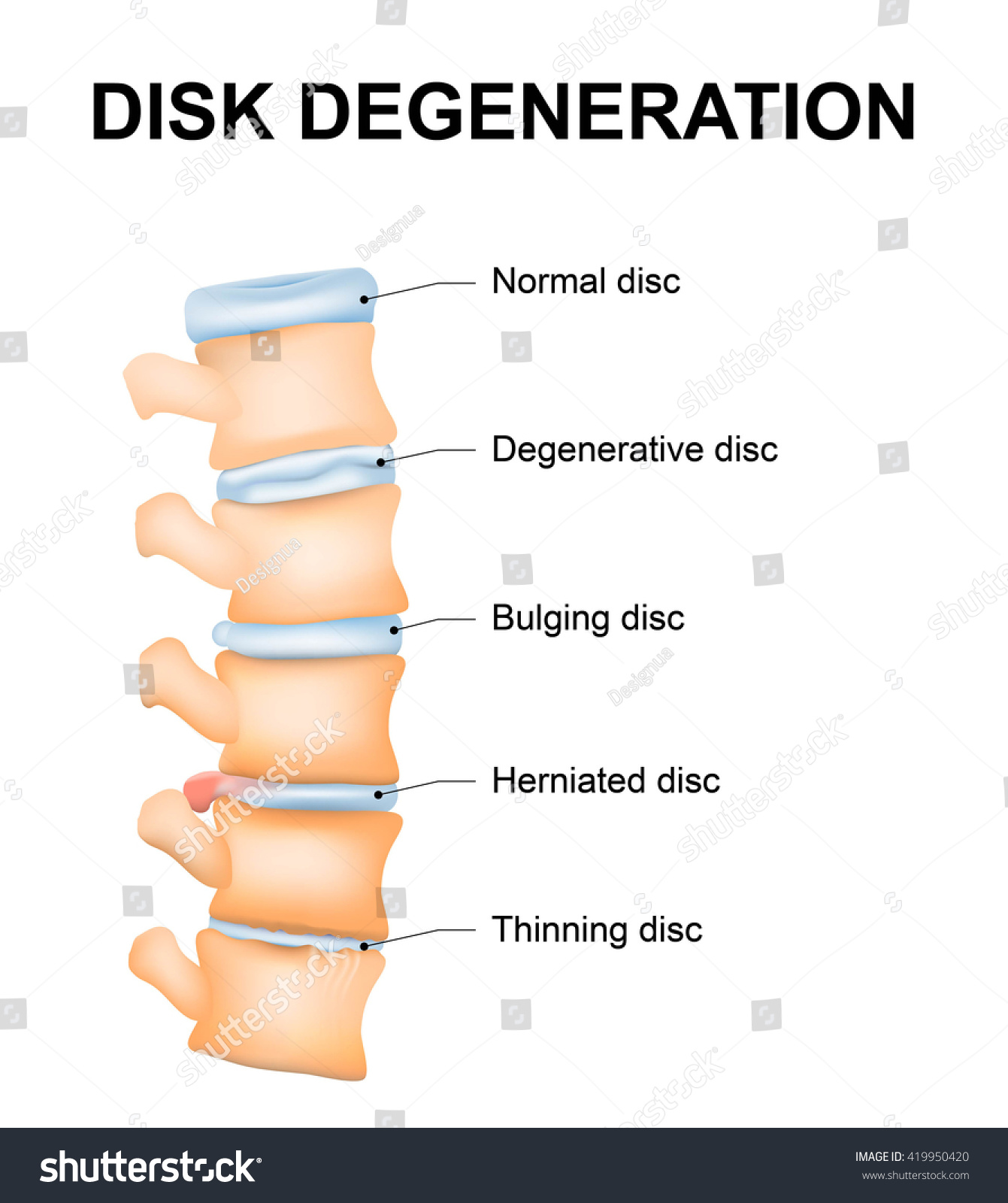 Disc degeneration it's the normal wear and tear - Royalty Free Stock ...