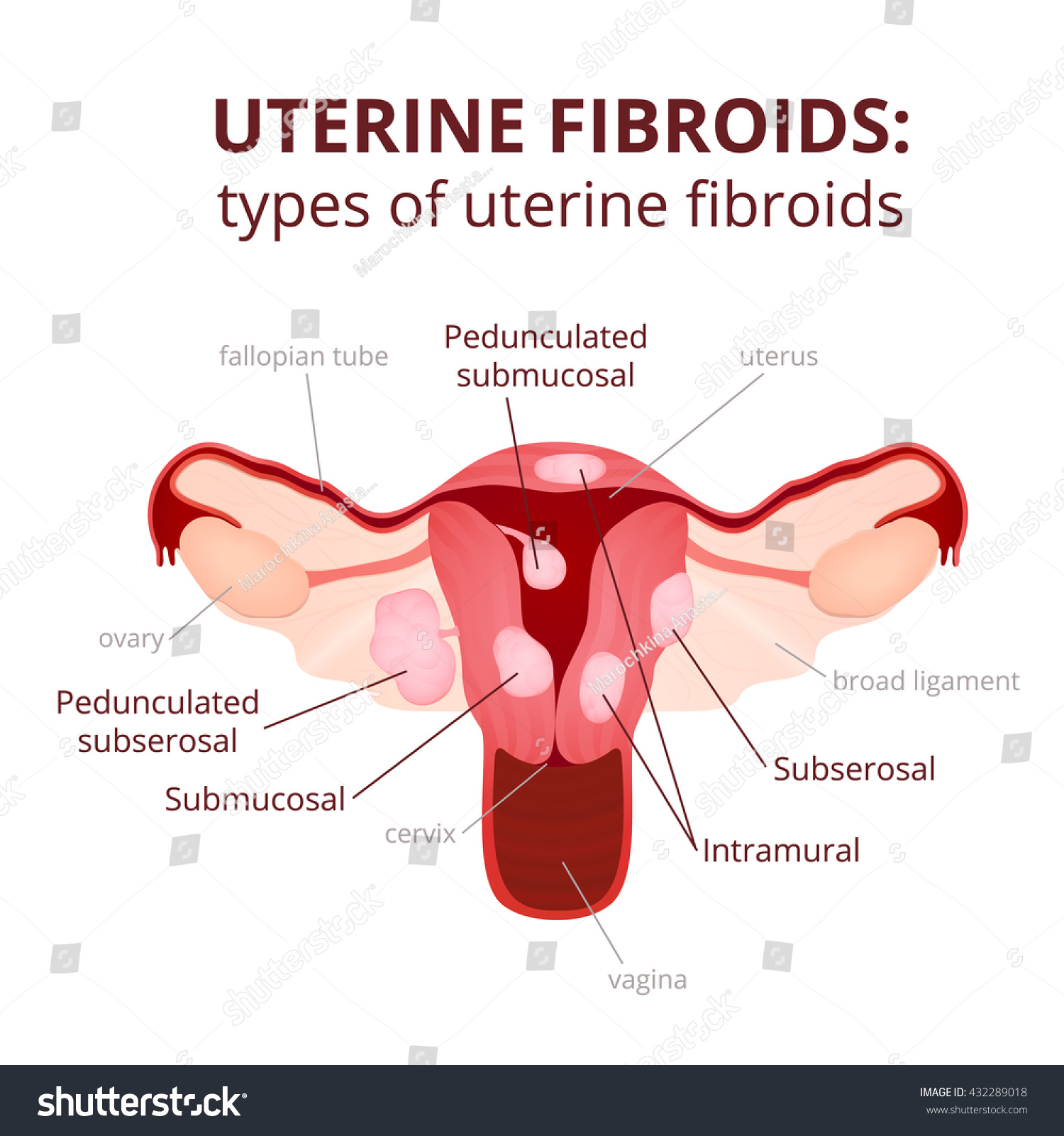 Uterine Fibroids Tumors Types Of Scheme Royalty Free Stock Vector