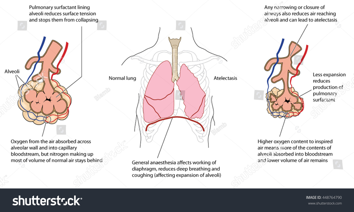 Atelectasis, or collapsed lung, with detail of - Royalty Free Stock ...