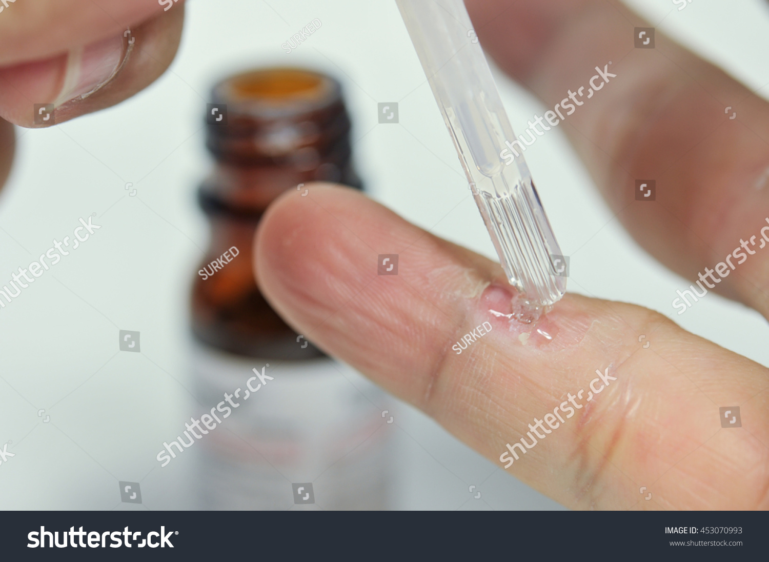 wart on finger with treatment by salicylic acid. wart on the finger verruca freeze concept blurred neutral background, selective focus, #453070993