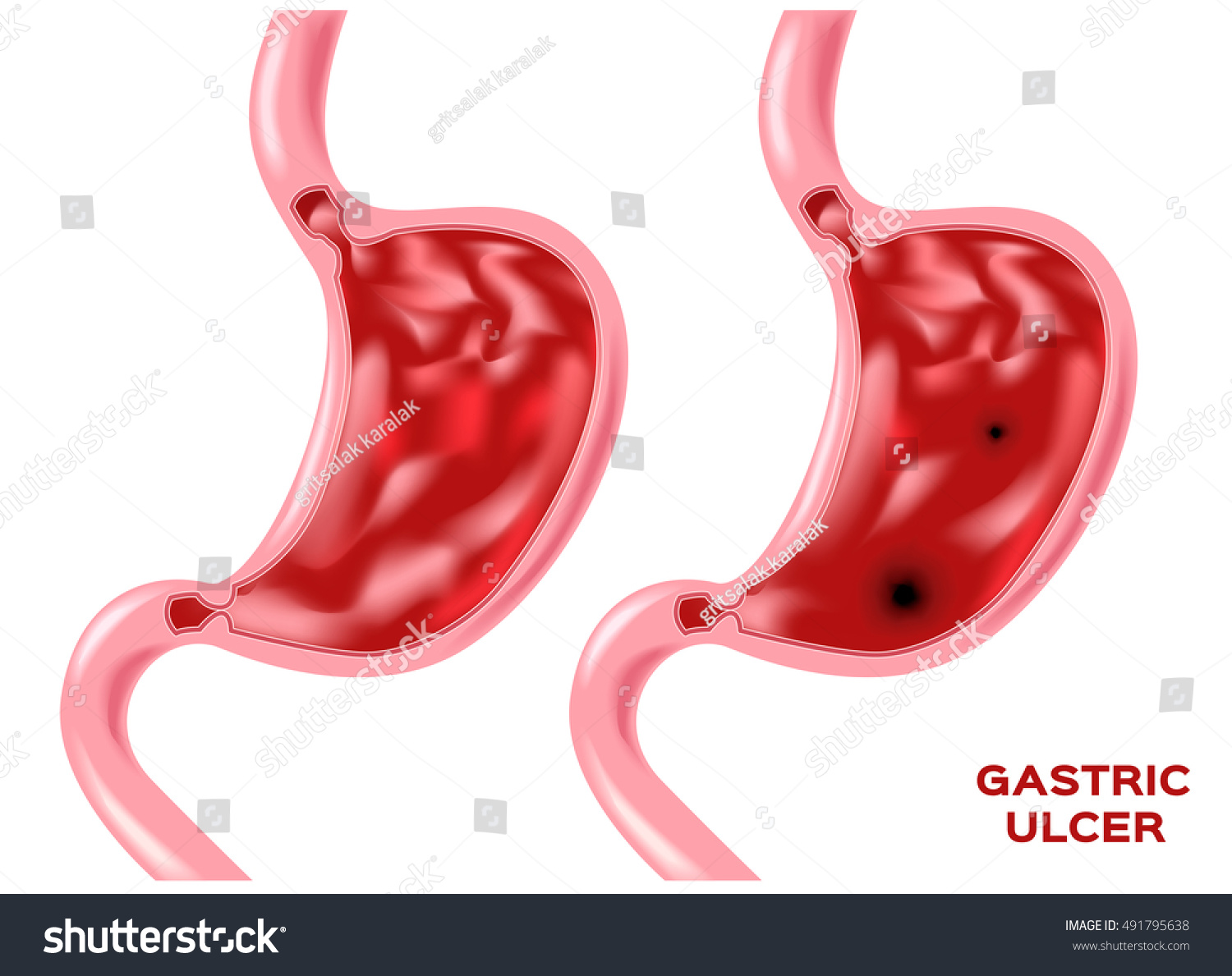 Peptic Ulcer Disease Pud Vector Illustration Royalty Free Stock Vector 491795638 