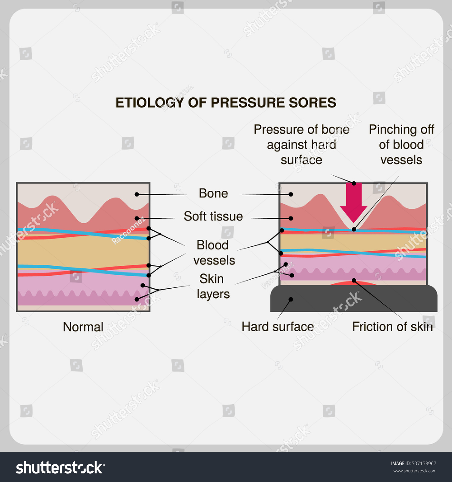 Etiology Of Pressure Sores Vector Illustration Royalty Free Stock