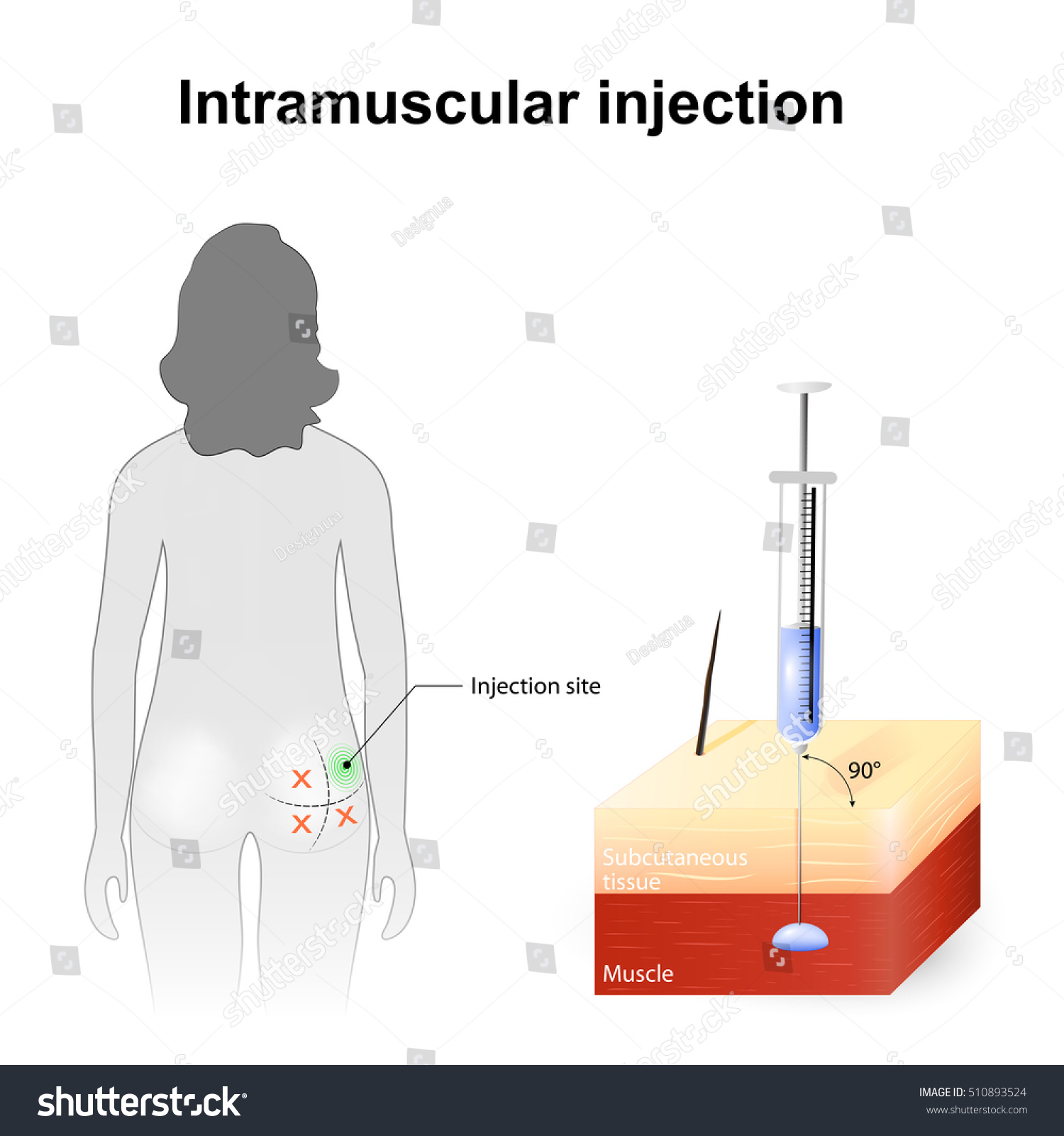 Intramuscular injection. Angle and depth of injections. Technique, rules and injection site of intramuscular route of administration.  #510893524