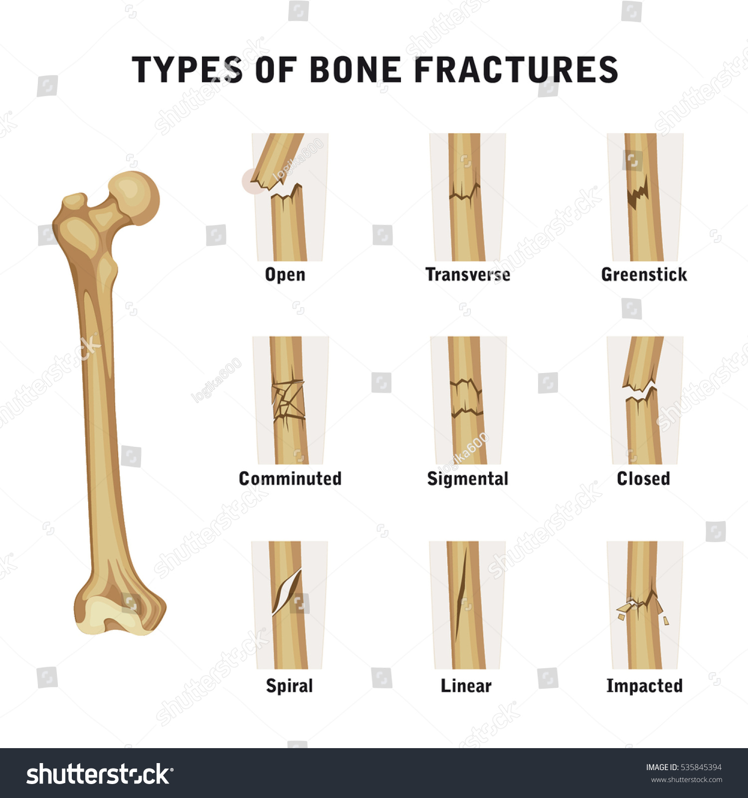 Types Of Bone Fractures - Royalty Free Stock Vector 535845394 - Avopix.com