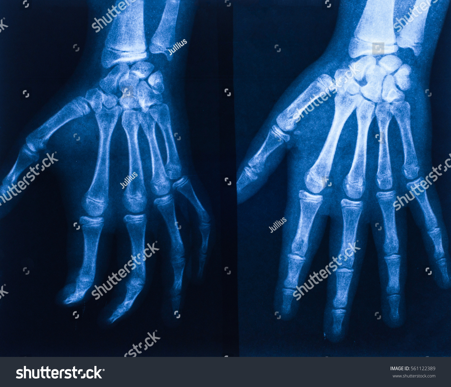 X-ray of hand. #561122389