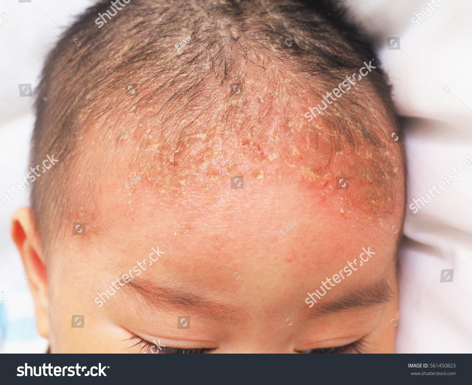 Royalty Free Seborrheic Dermatitis On Head In Asian 561450823