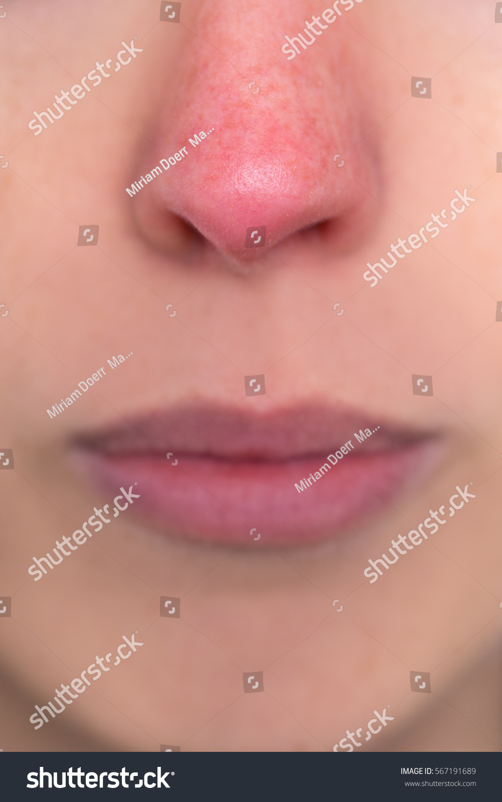 close up, young woman with a red nose, allergy, hypothermia or rosacea #567191689