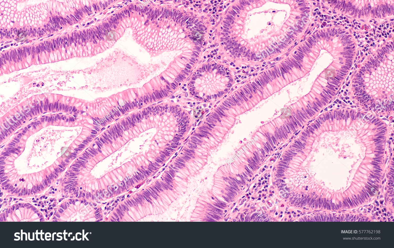 Microscopic (histology) of tubular adenoma. Adenomas are premalignant (precancerous) polyps of colon and rectum. Colonoscopy can prevent cancer by removing adenomas before they transform to cancer. #577762198