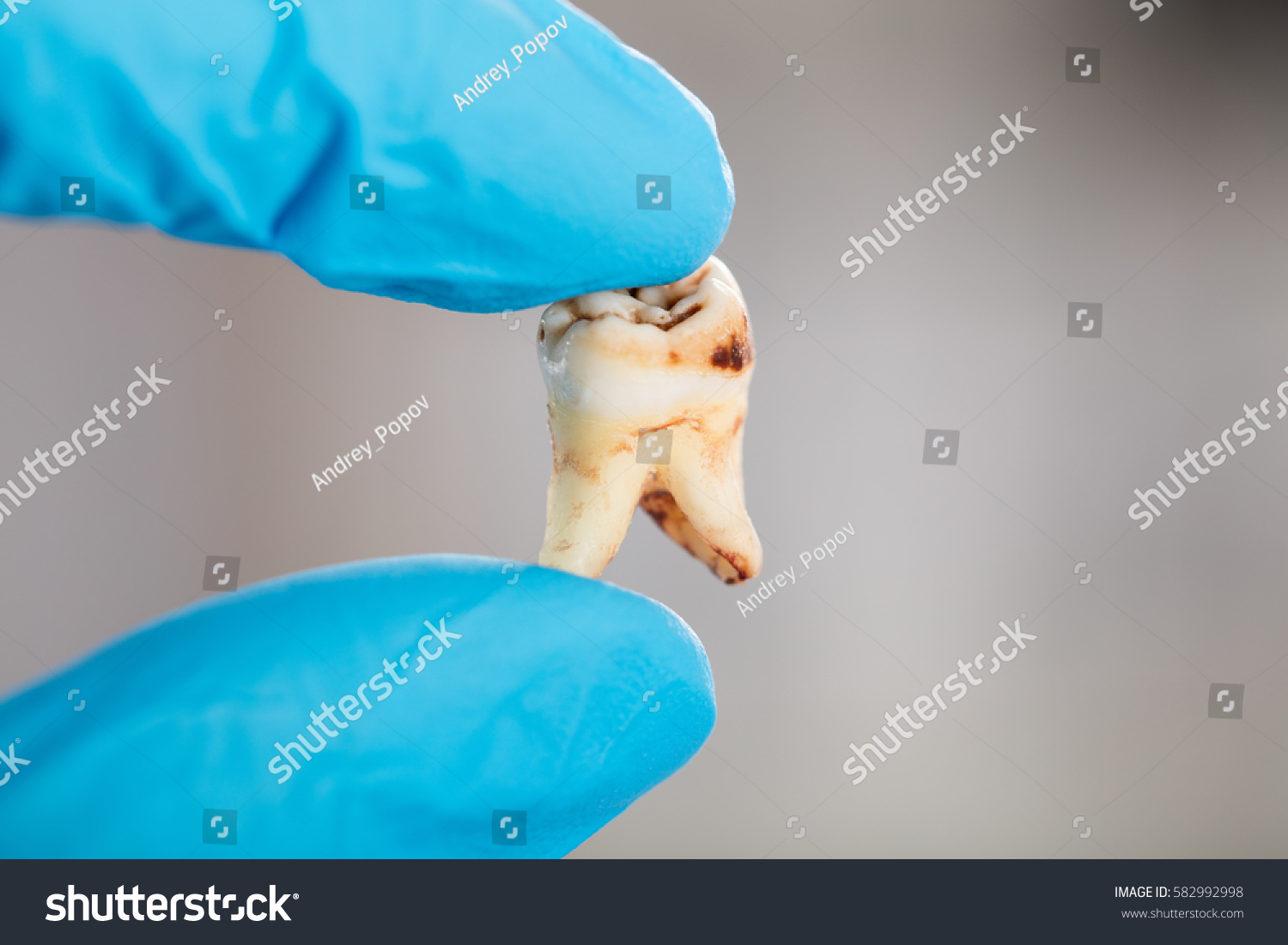 Close-up Of Dentist Hand In Glove Holding Decay Tooth #582992998