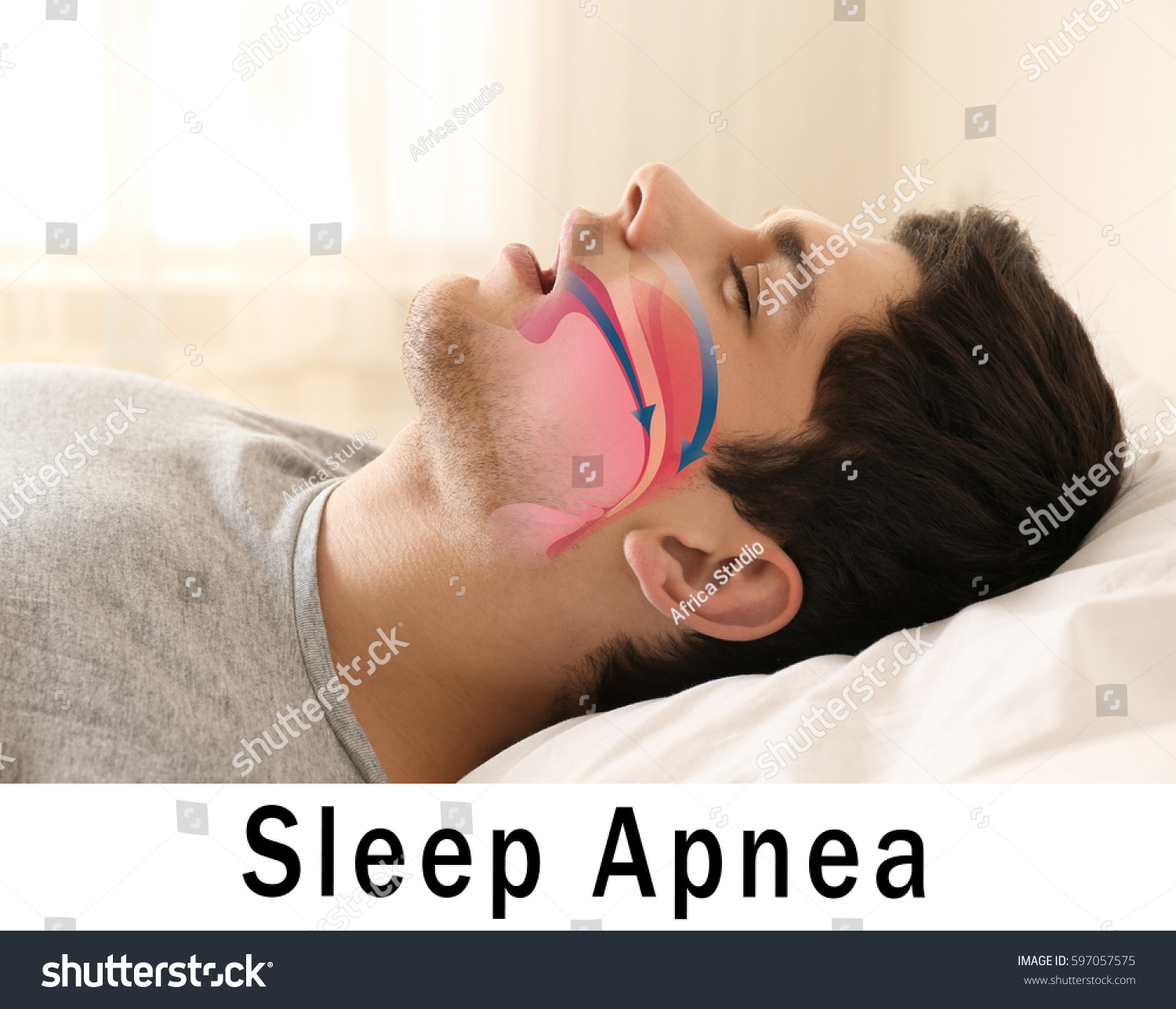 Snore problem concept. Illustration of obstructive sleep apnea #597057575