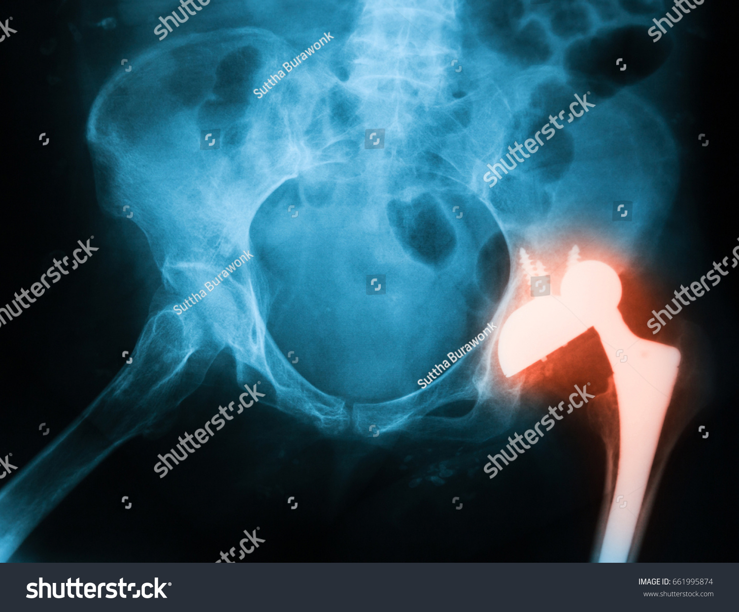 X-ray image of both hip, anteroposterior(AP) view,  showing dislocation of the total hip arthroplasty implant at left #661995874