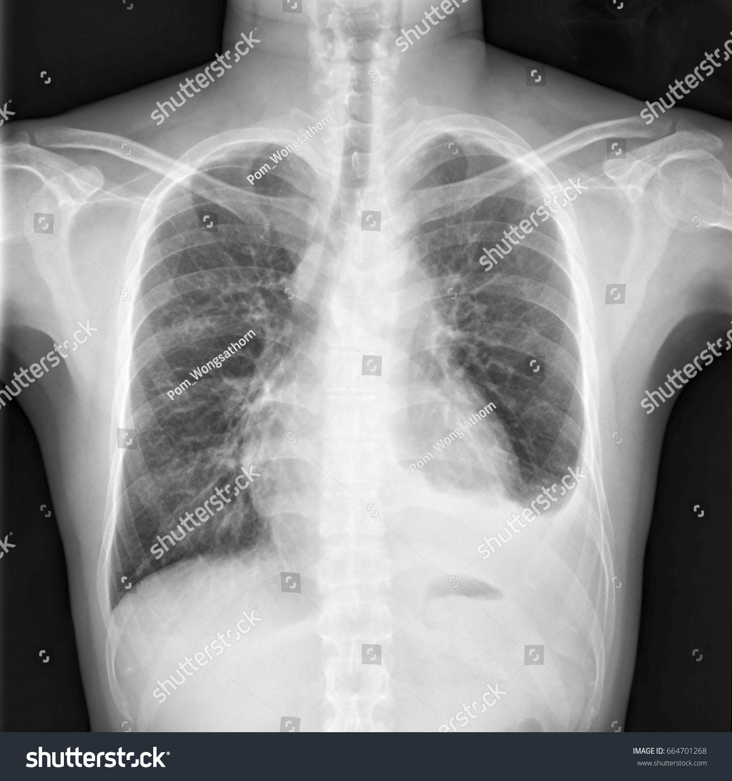 Chest X-ray Shows Cardiomegaly (enlarged Heart) - Royalty Free Stock 