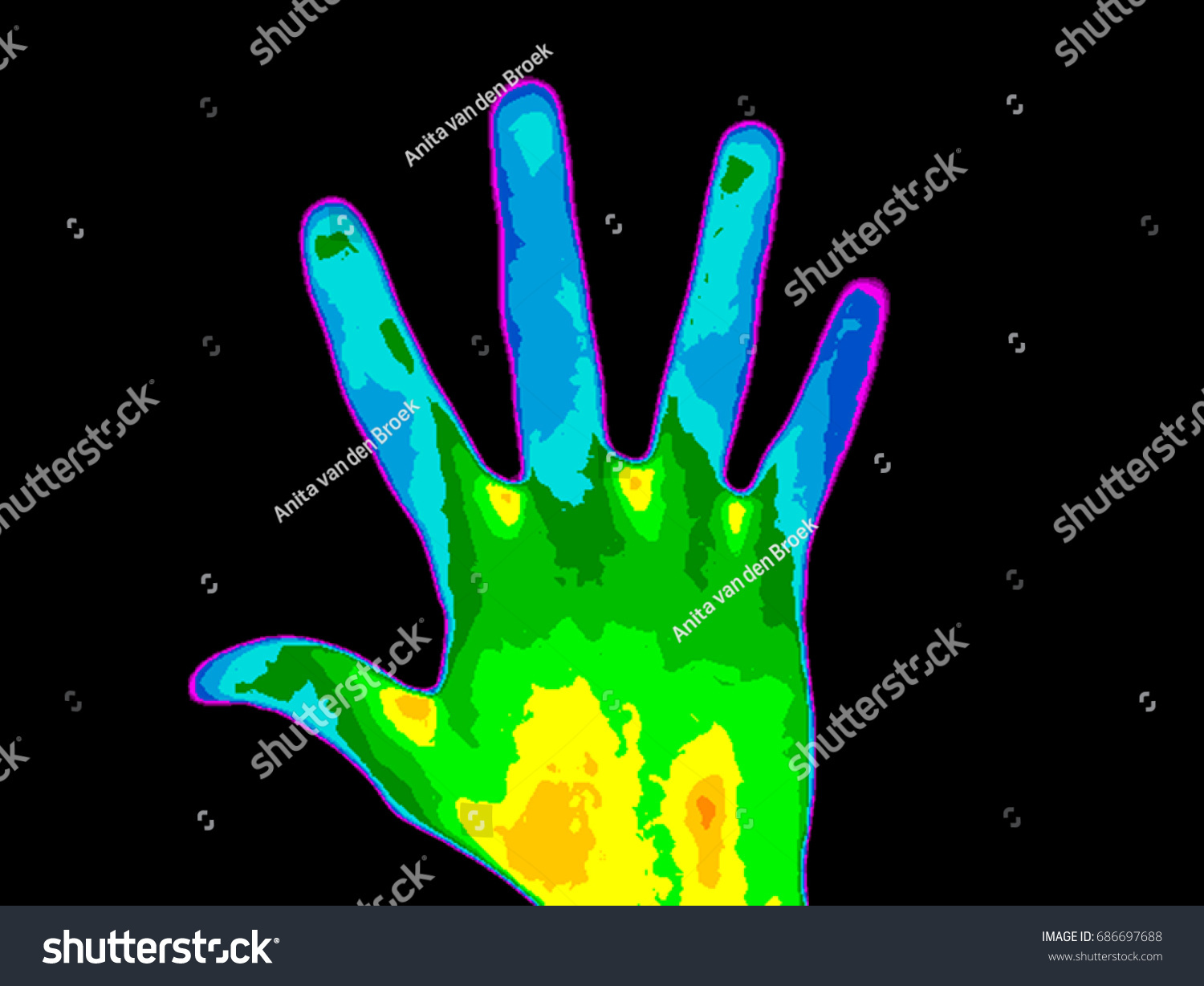 Thermographic photo of palm of a persons hand with the photo showing different temperature in a range of colors from blue showing cold to red showing hot, blue fingers can indicate multiple sclerosis. #686697688