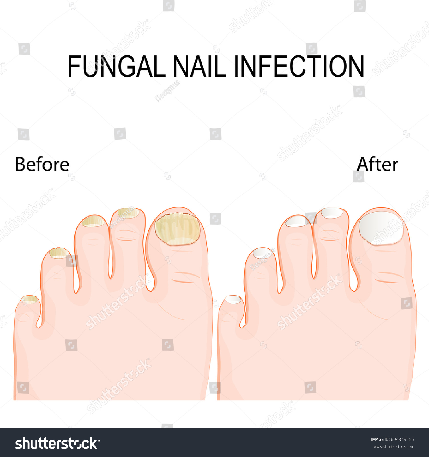 fungal nail infection. Onychomycosis or tinea - Royalty Free Stock ...