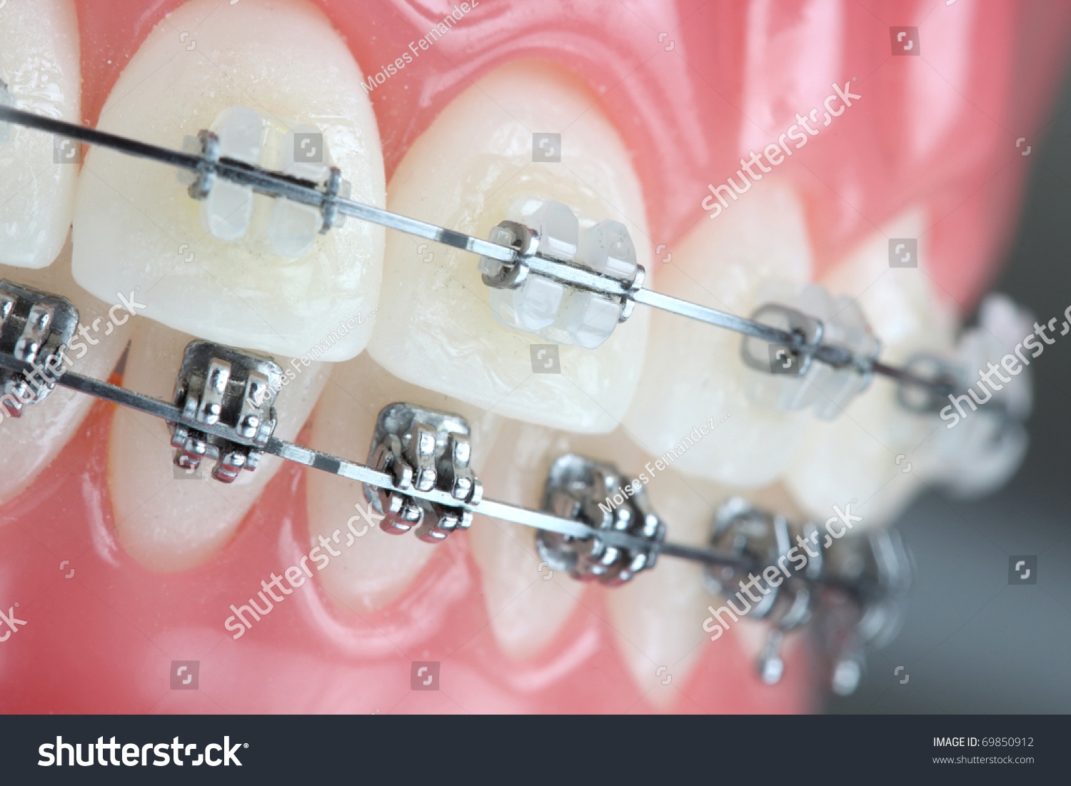 Denture with braces #69850912