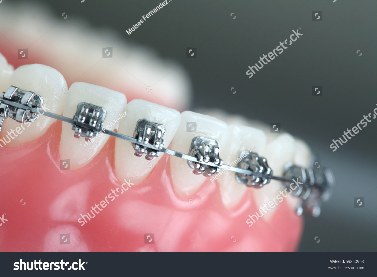 Denture with braces #69850963