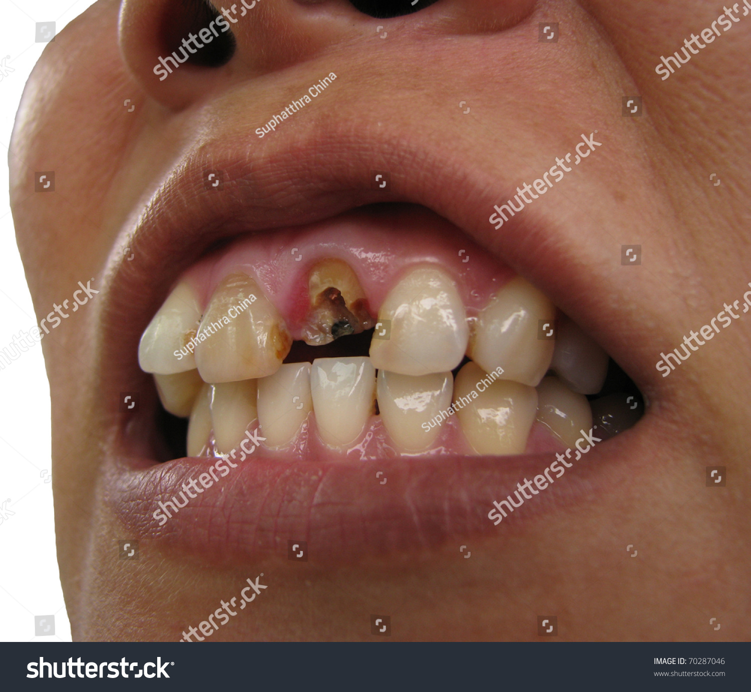 Broken tooth upper right central incisor frontal view #70287046