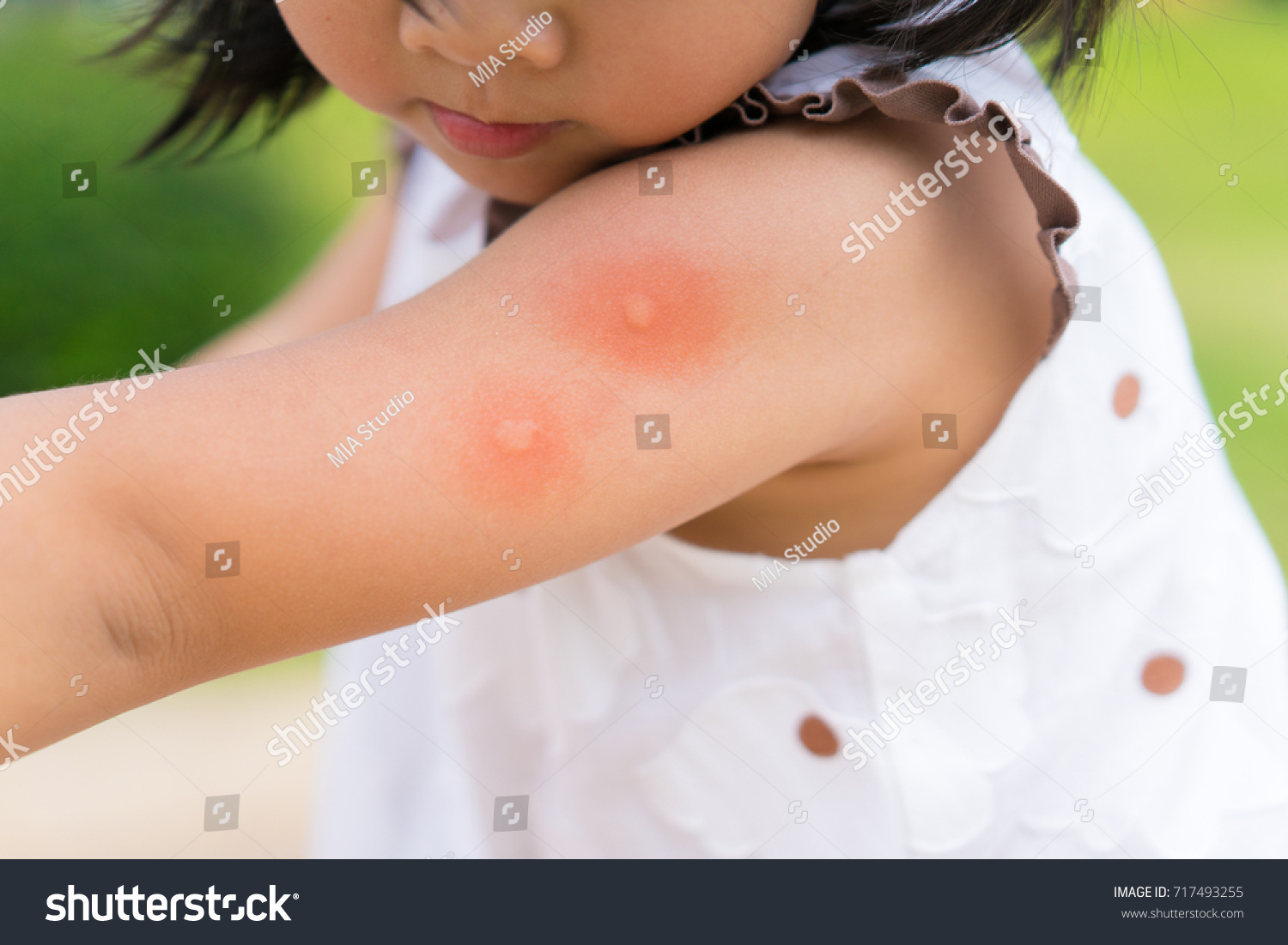 Little girl has allergies with mosquitoes bite and itching her arm.Mosquito blood breeding on kids.Repellent, Dengue virus, Yellow fever, West nile, Malaria, Diseases Spread by Mosquitoes concept. #717493255